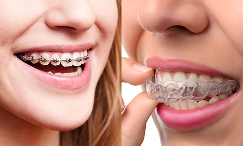 clear aligners