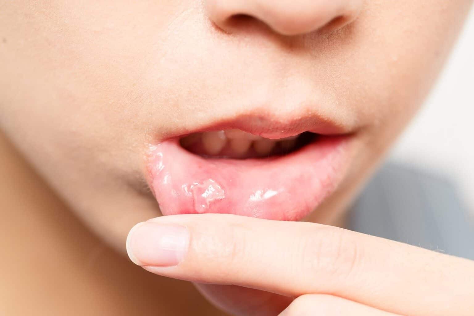 Canker Sores Sala Family Dentistry Canker Sores Sala Family Dentistry