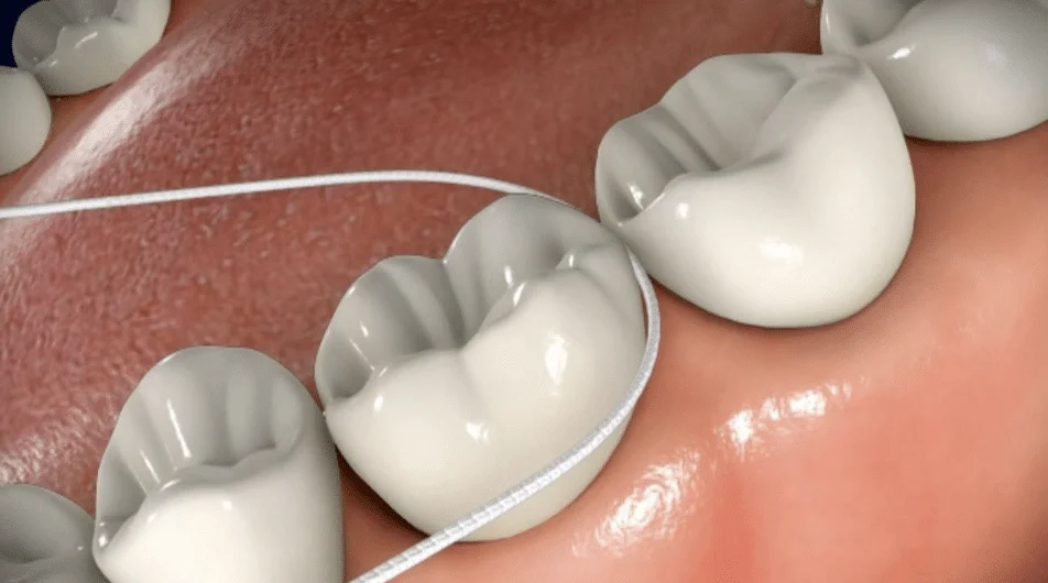 flossing 1