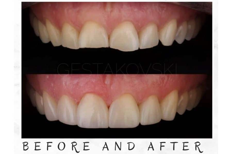 injectable veneer cover photo