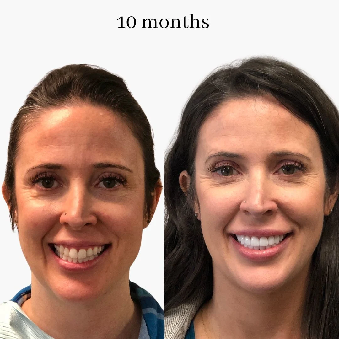 invisalign before & after – 2024.02 (1)