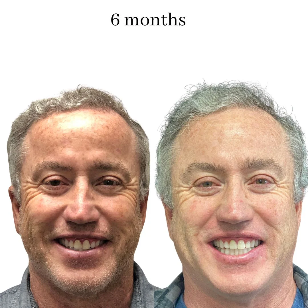 invisalign before & after – 2024.02 (11)