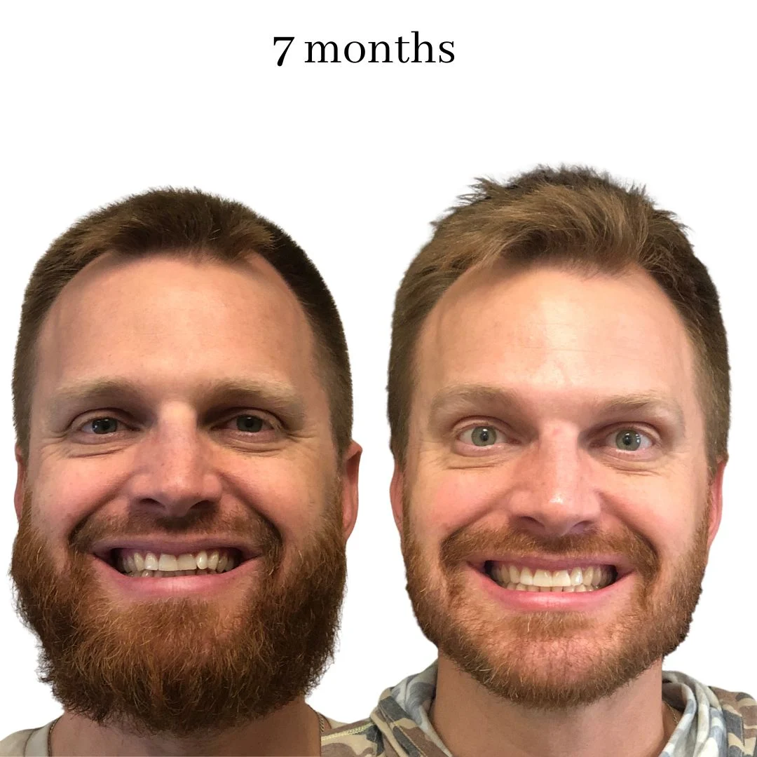 invisalign before & after – 2024.02 (12)