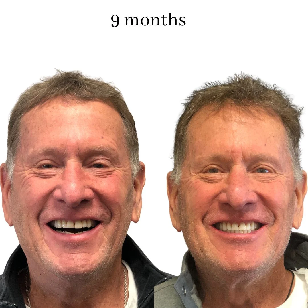 invisalign before & after – 2024.02 (13)
