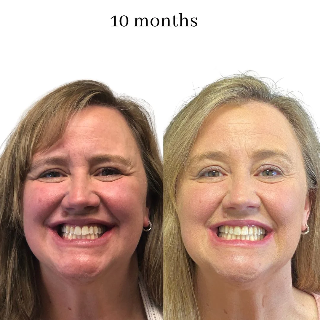 invisalign before & after – 2024.02 (14)