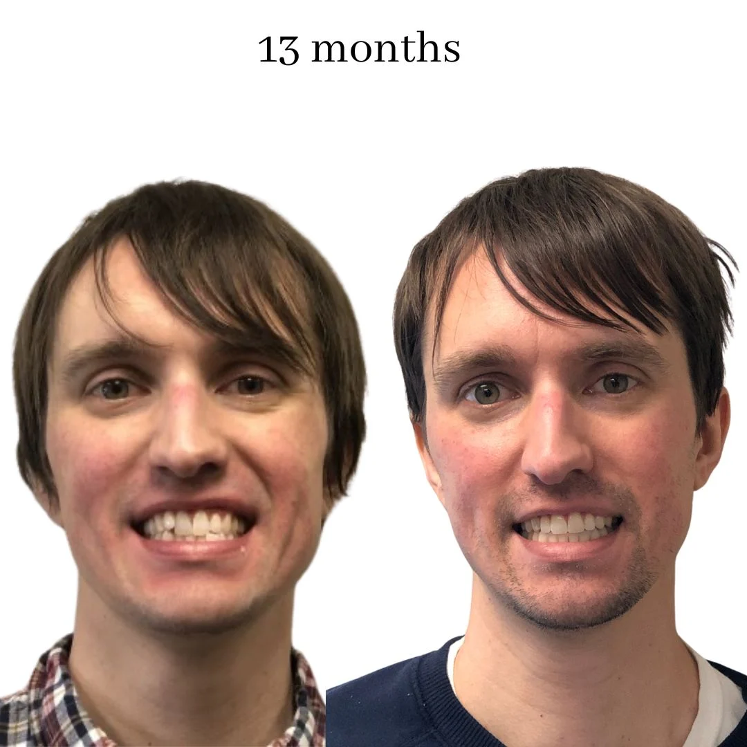 invisalign before & after – 2024.02 (15)