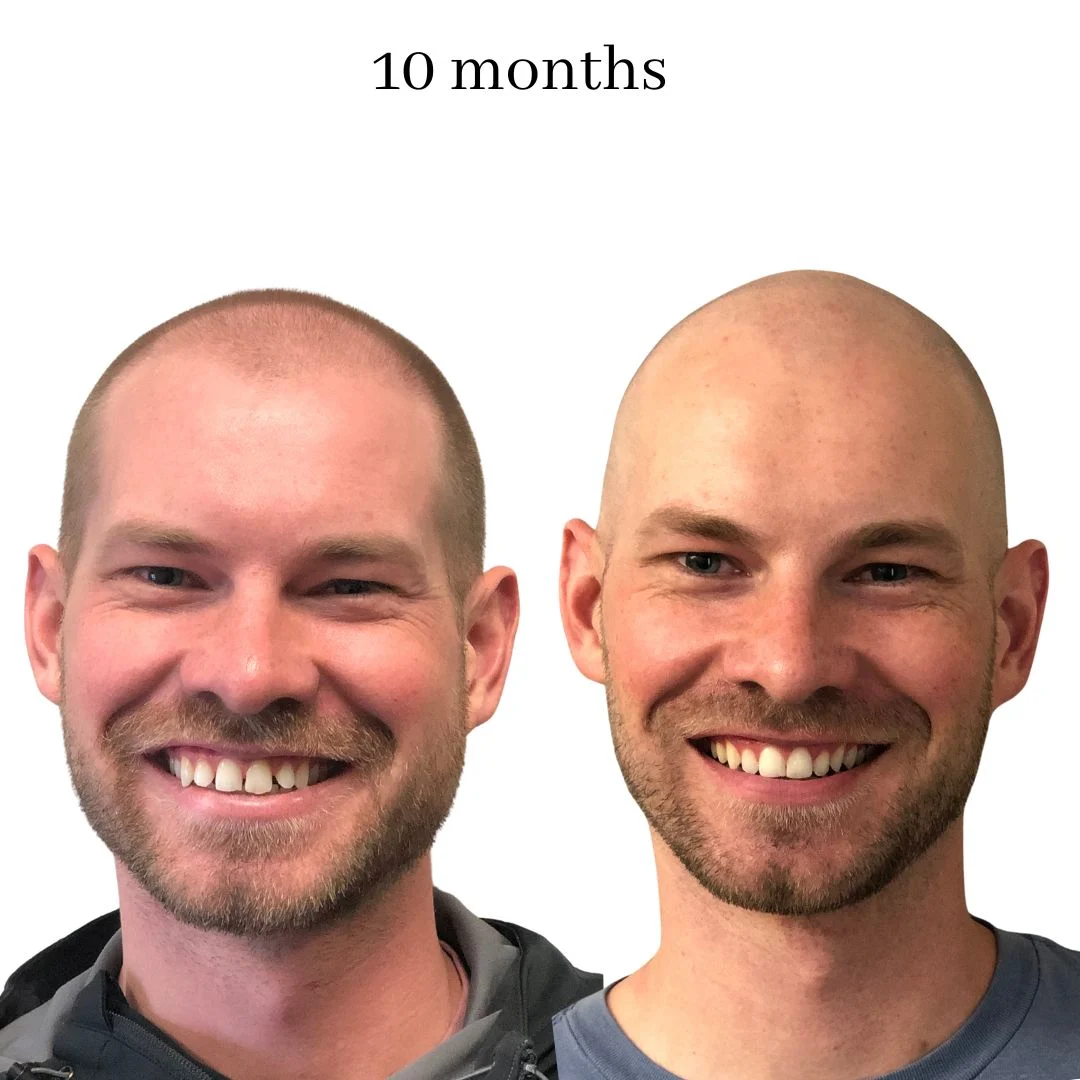 invisalign before & after – 2024.02 (16)