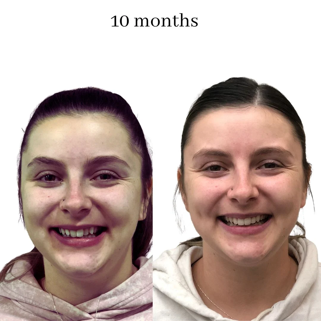 invisalign before & after – 2024.02 (17)
