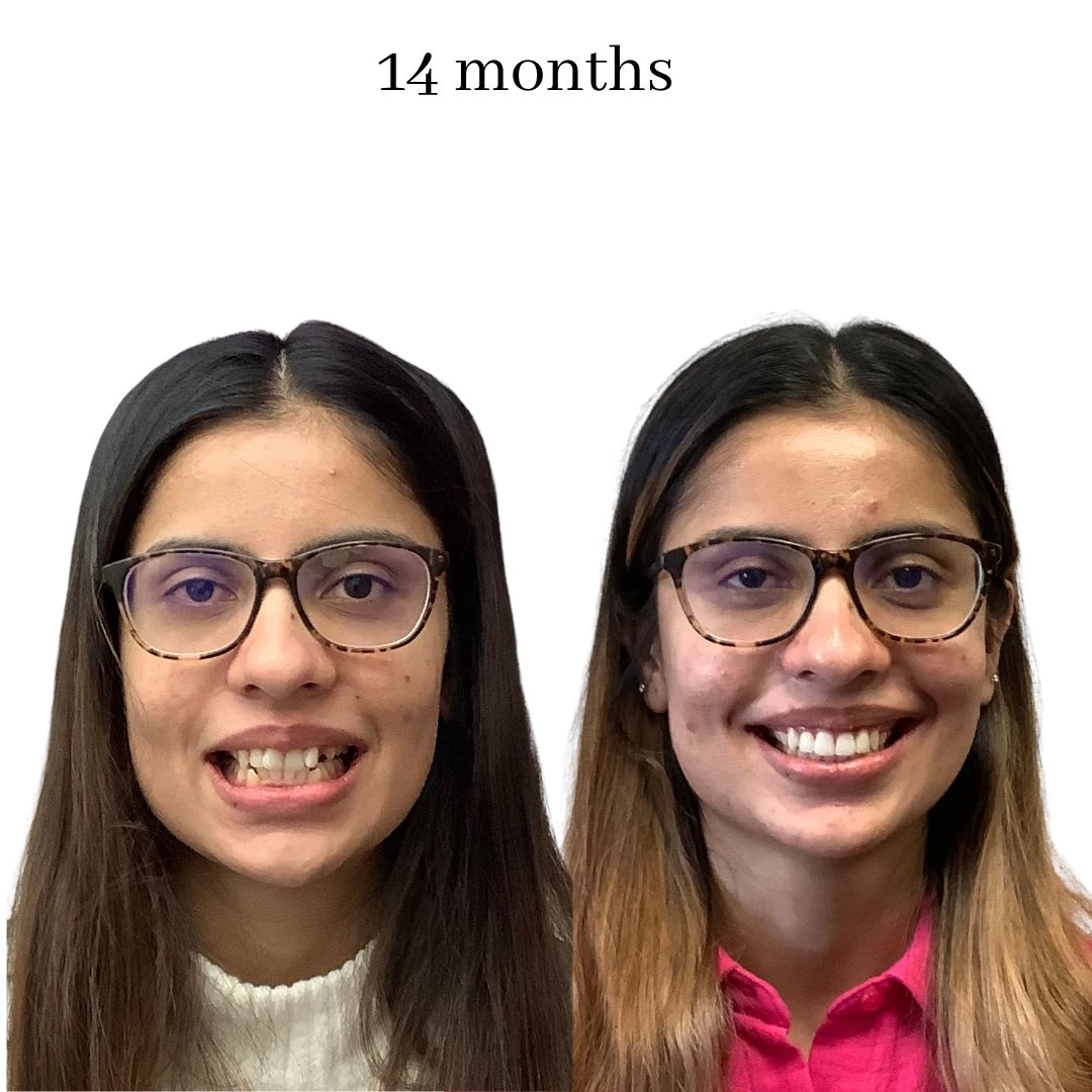 invisalign before & after – 2024.02 (18)