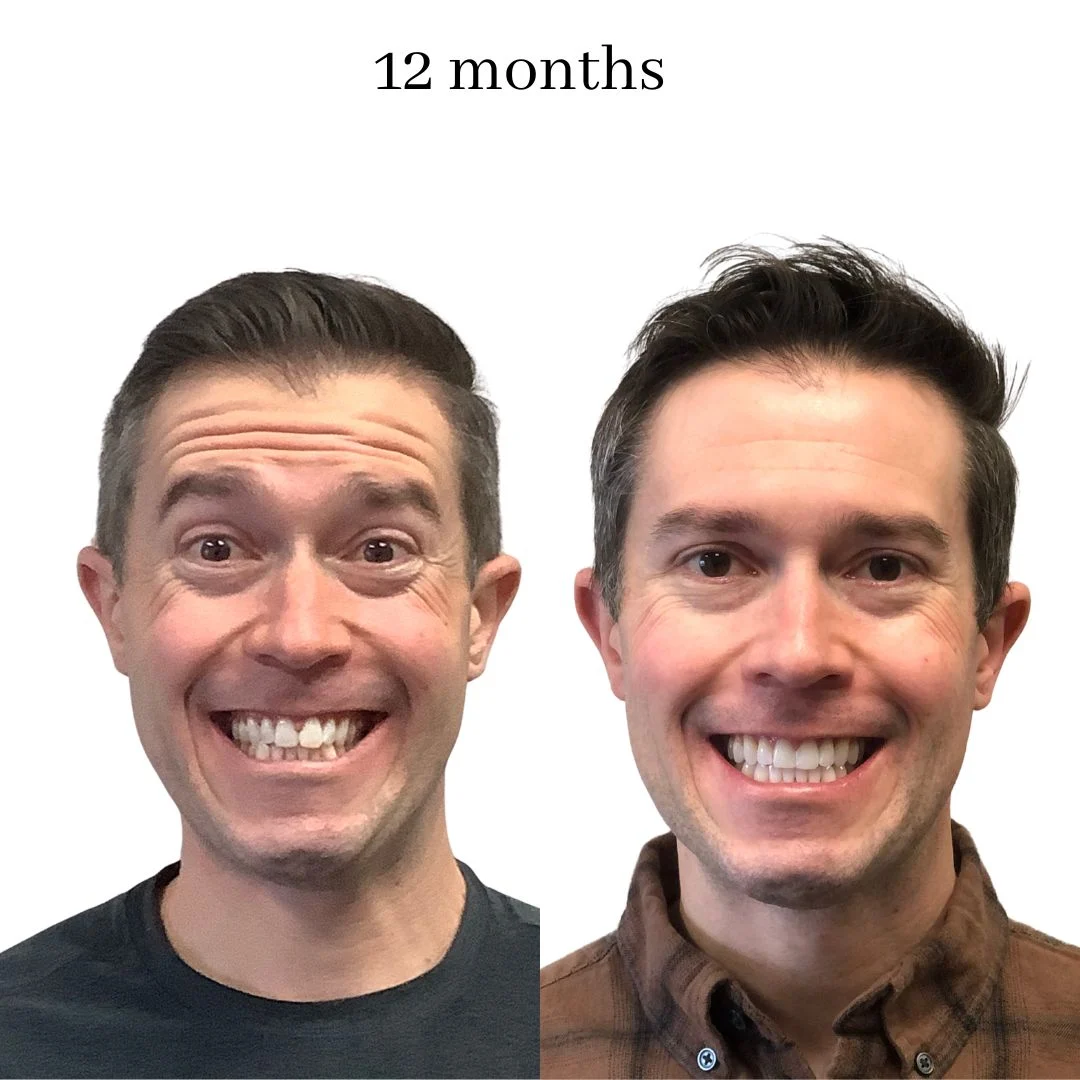 invisalign before & after – 2024.02 (19)