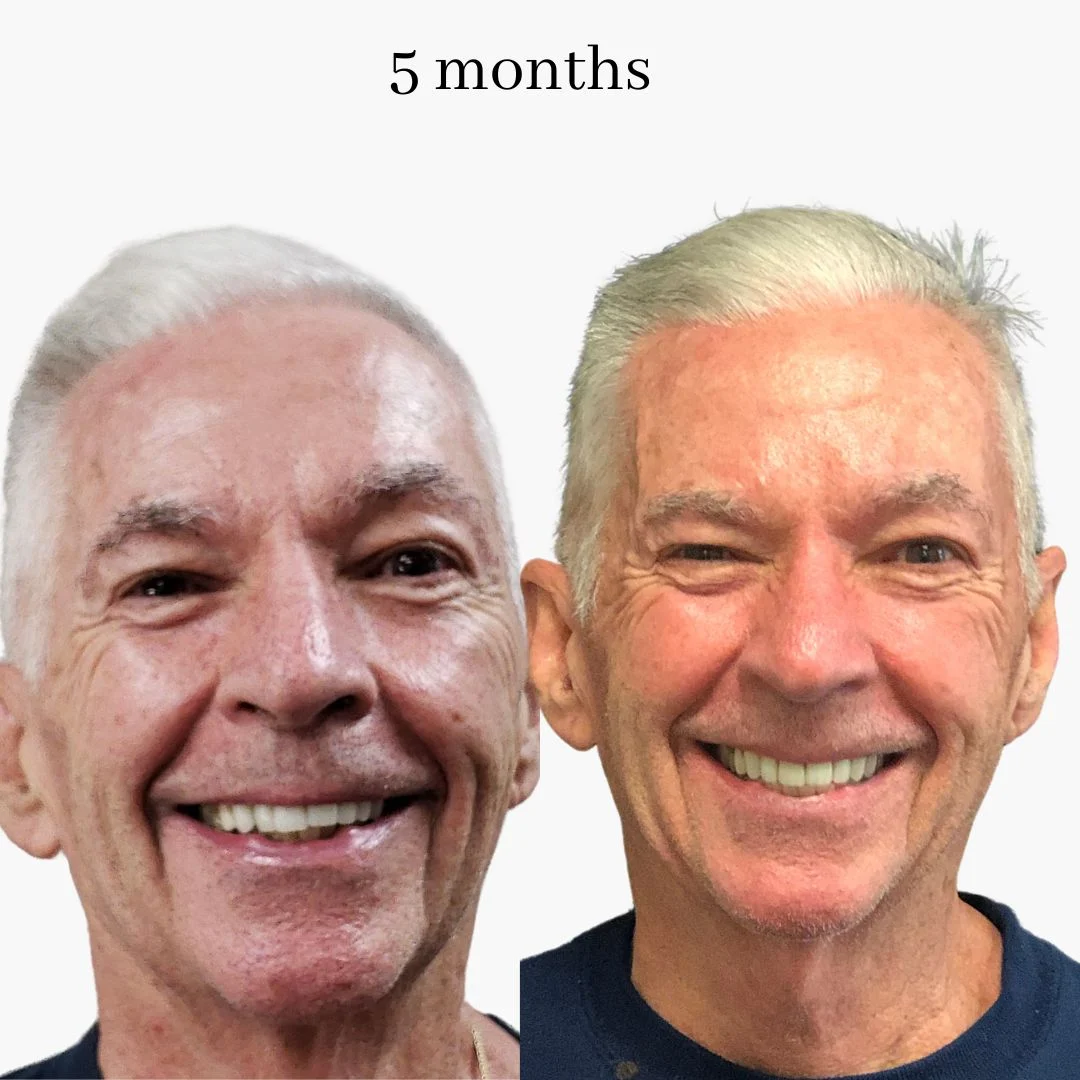 invisalign before & after – 2024.02 (2)