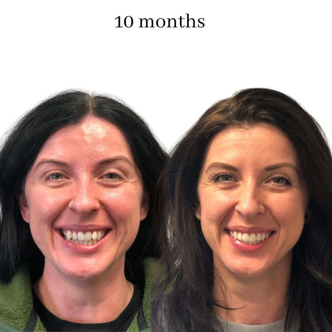 invisalign before & after – 2024.02 (23)