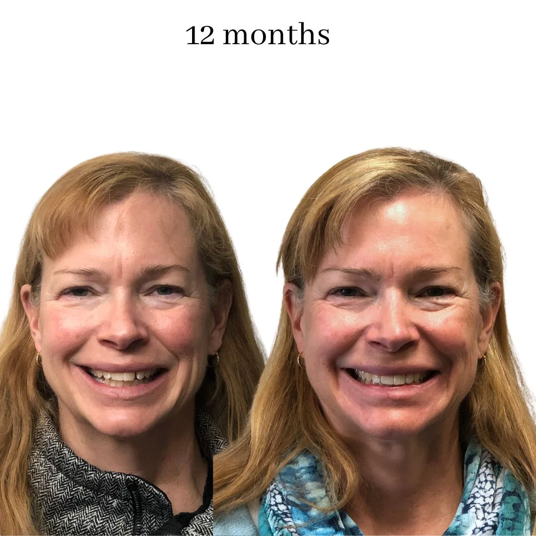 invisalign before & after – 2024.02 (24)