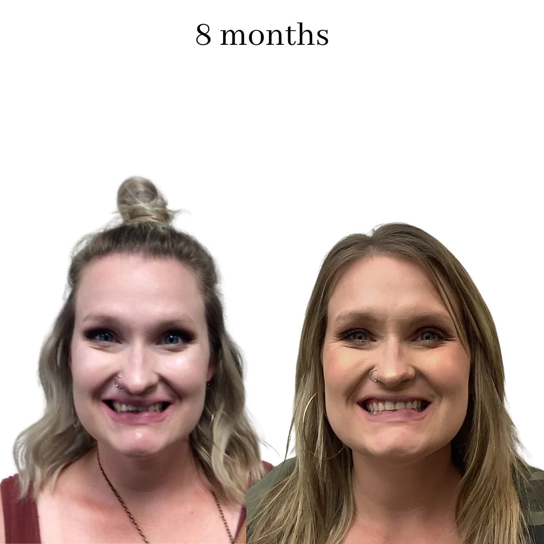 invisalign before & after – 2024.02 (25)