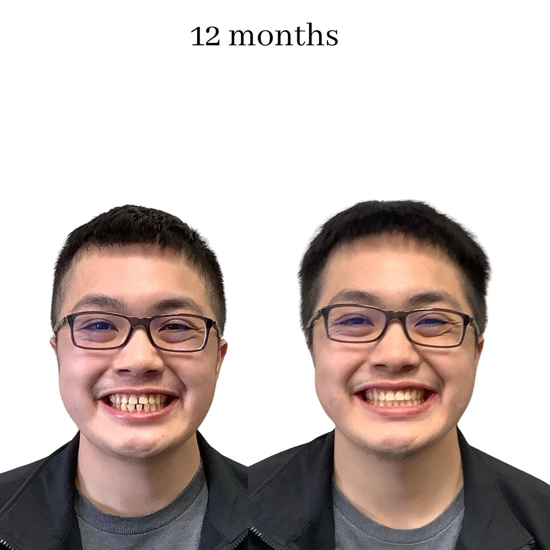 invisalign before & after – 2024.02 (26)