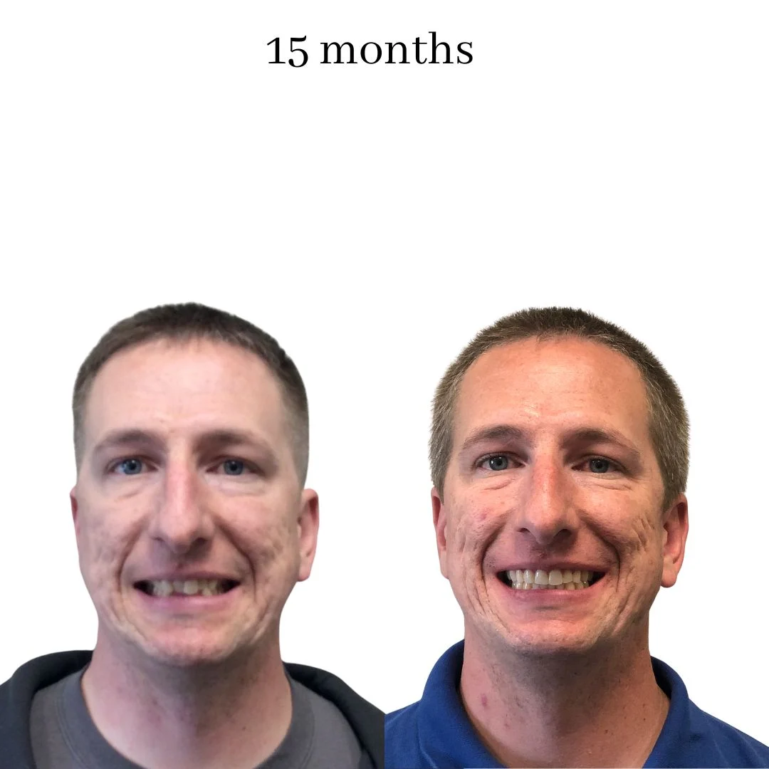 invisalign before & after – 2024.02 (27)