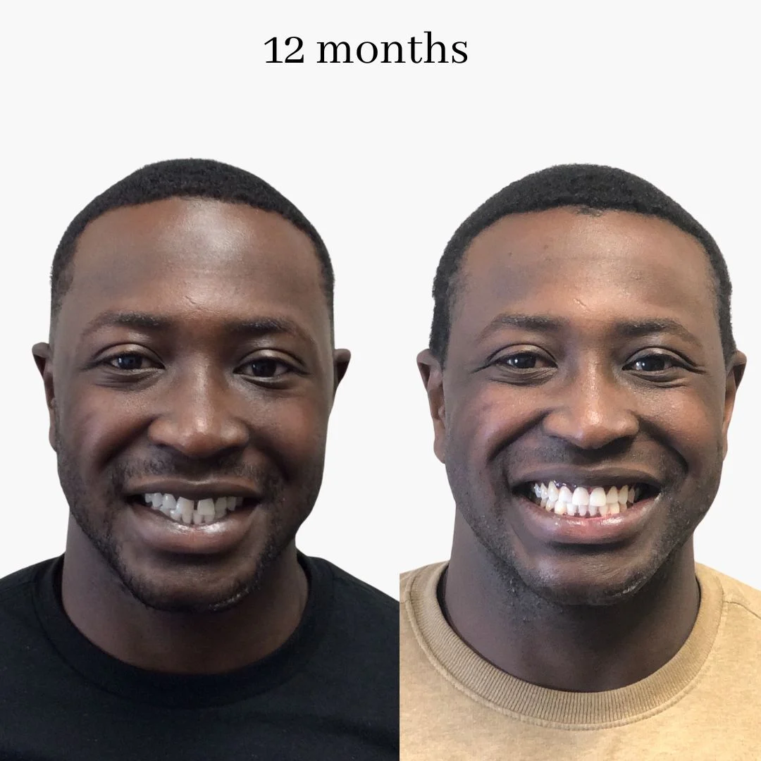 invisalign before & after – 2024.02 (3)