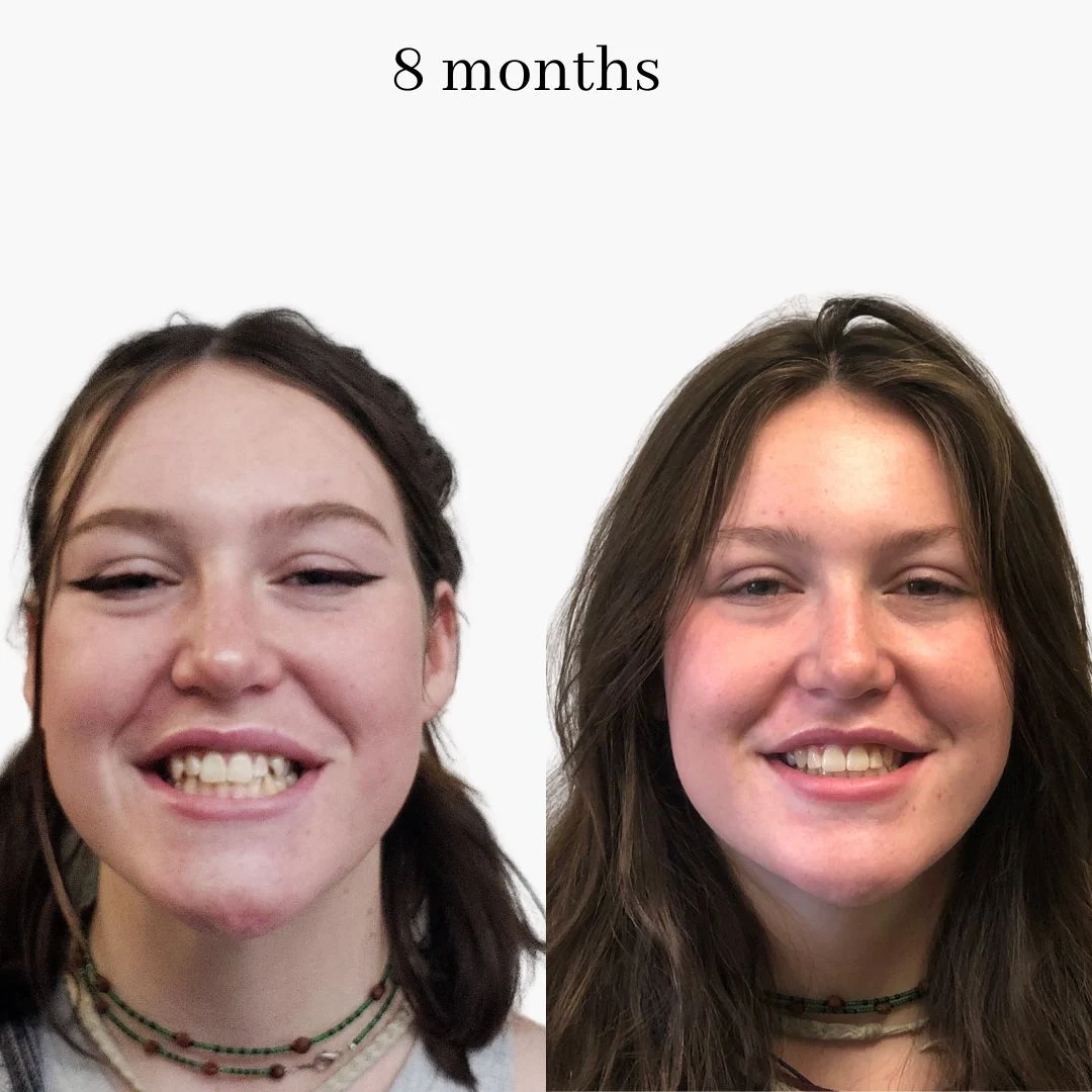 invisalign before & after – 2024.02 (4)