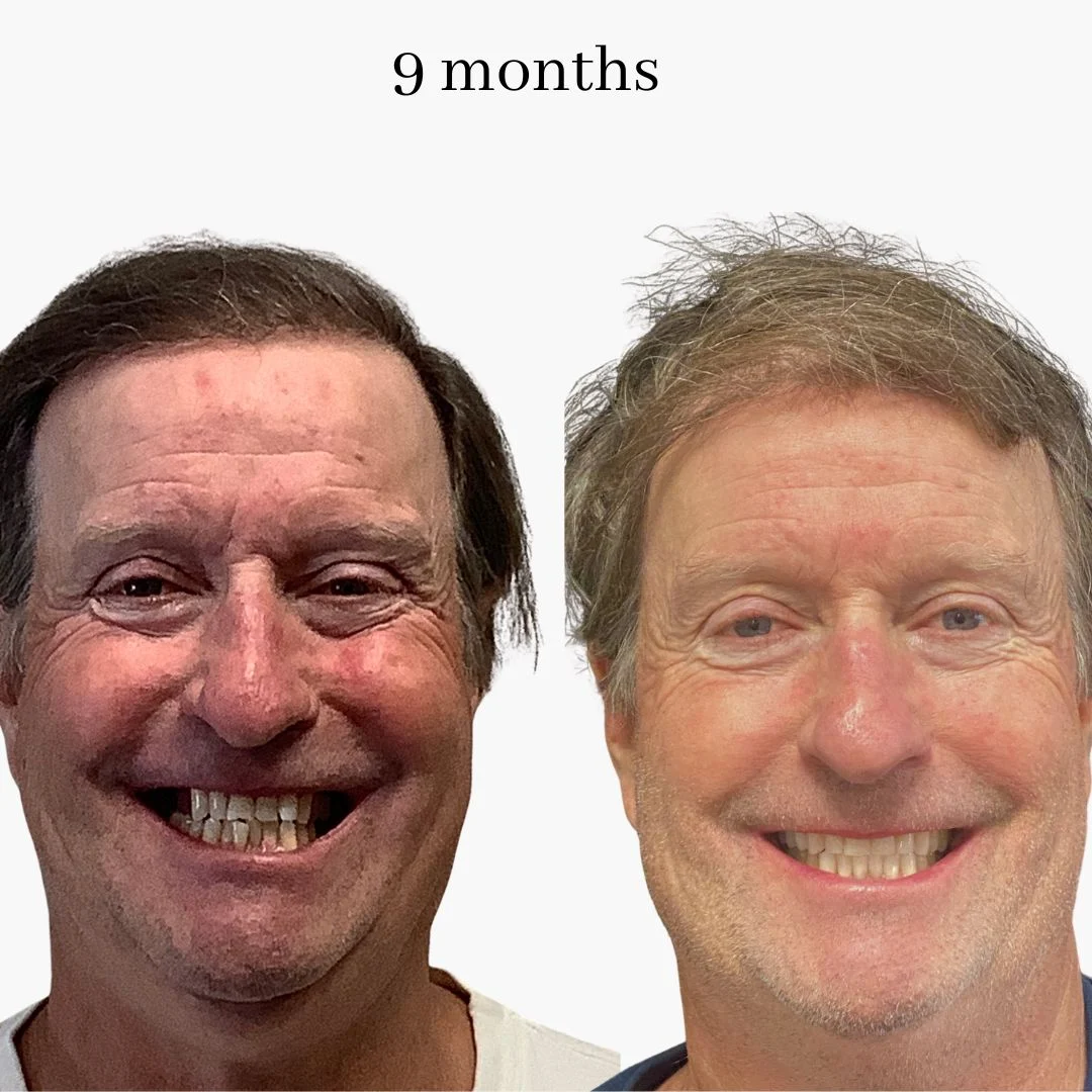 invisalign before & after – 2024.02 (6)
