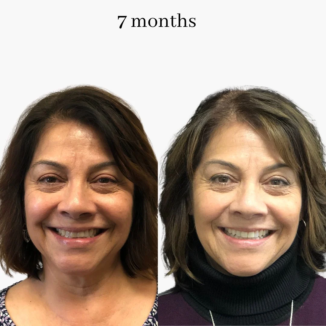 invisalign before & after – 2024.02 (7)