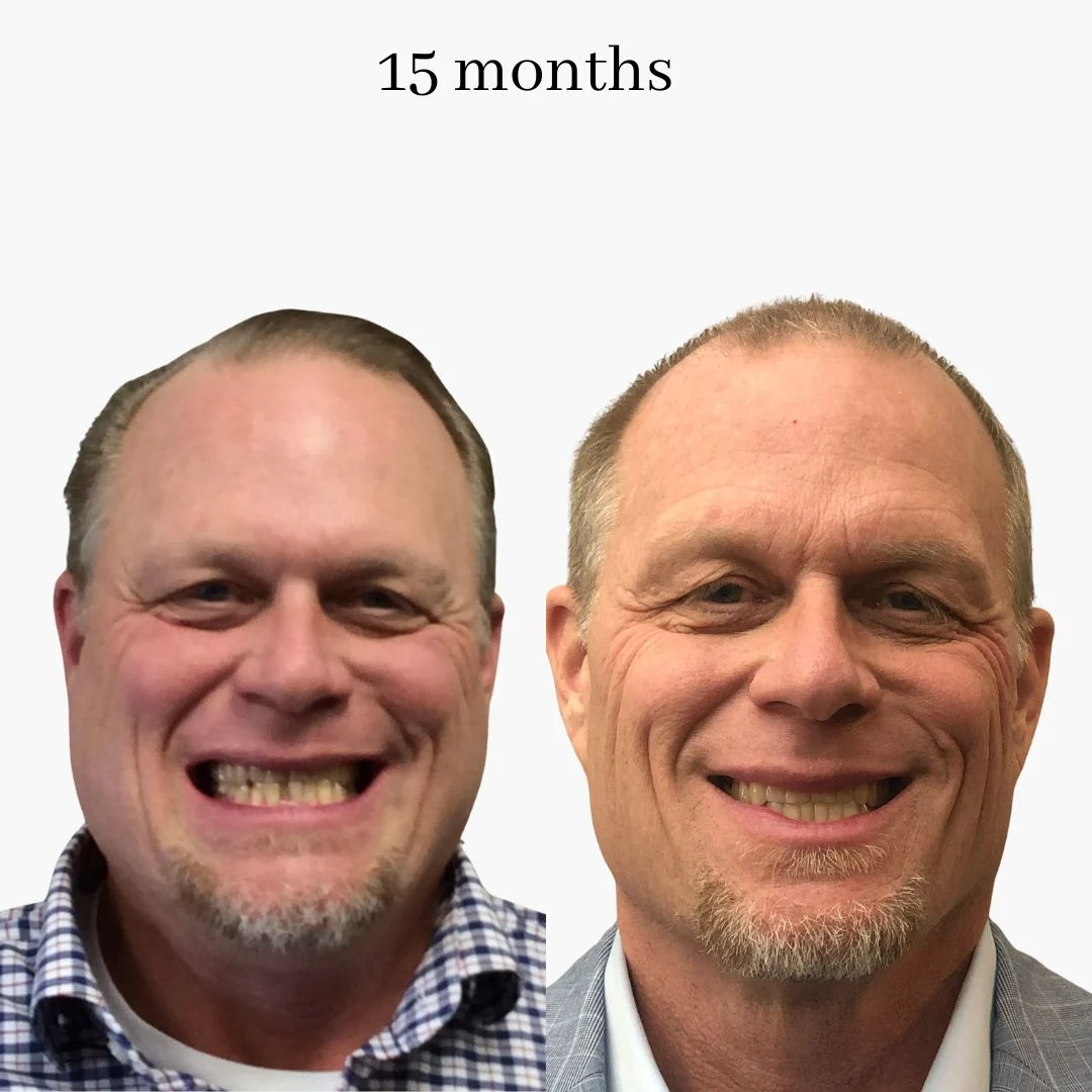 invisalign before & after – 2024.02 (9)