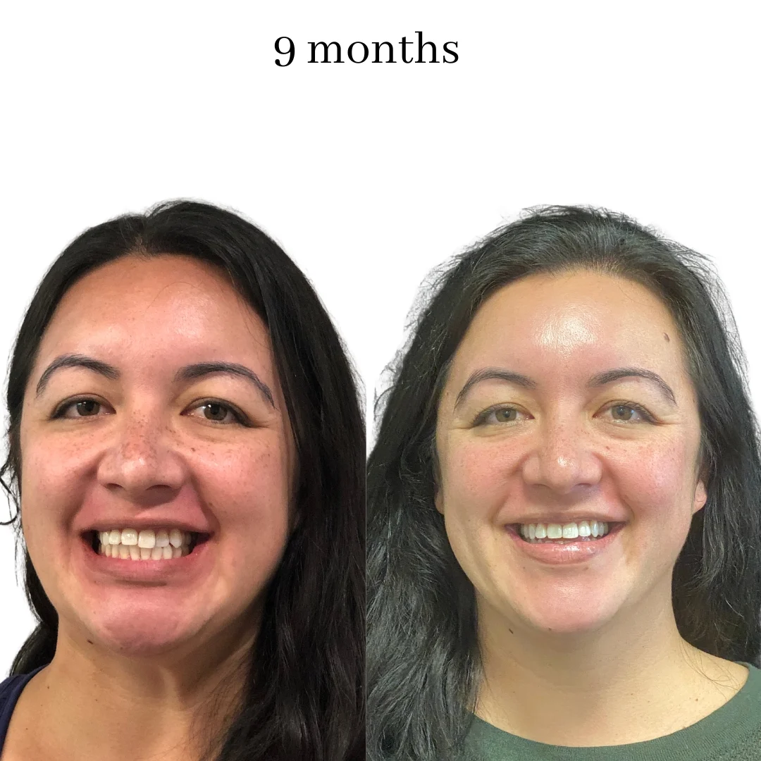 invisalign before & after – 2024.06 (37)