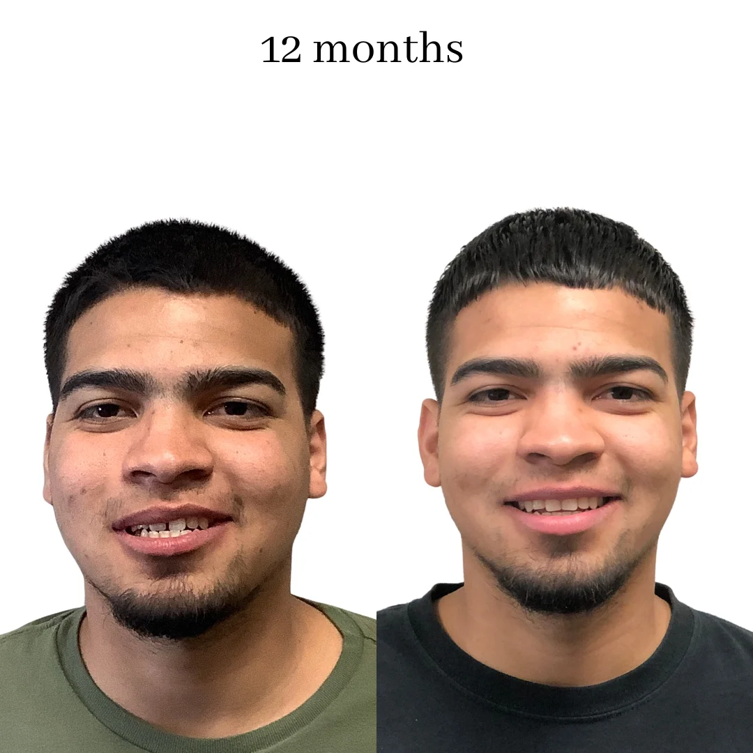 invisalign before & after – 2024.06 (39)