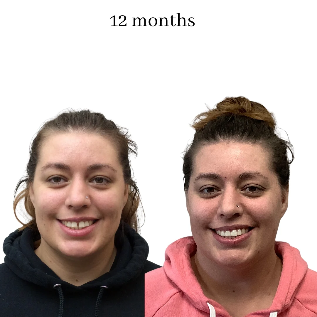 invisalign before & after – 2024.06 (40)