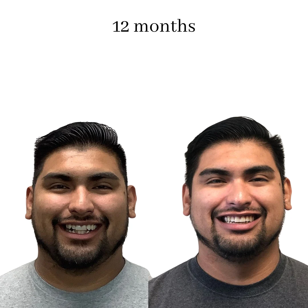 invisalign before & after – 2024.06 (41)