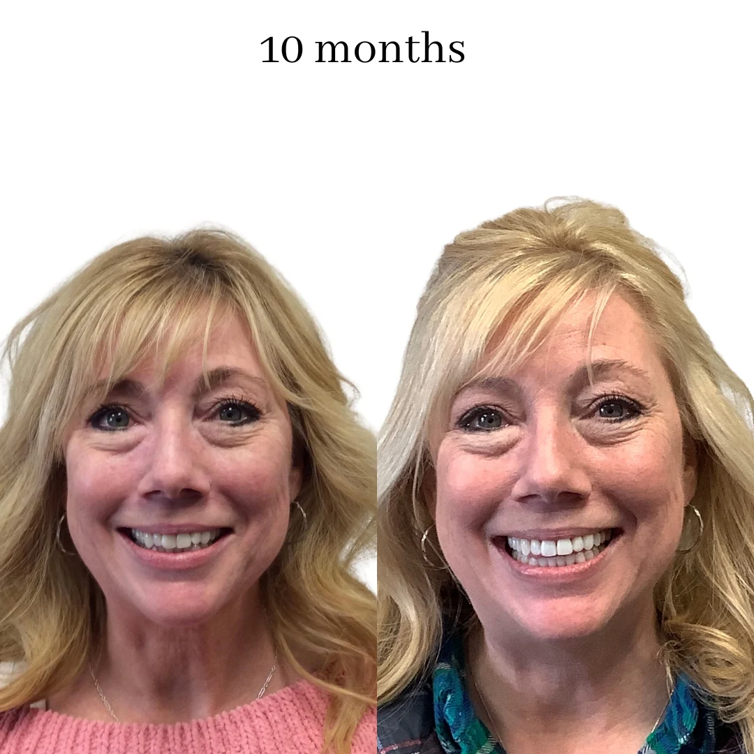 invisalign before & after – 2024.06 (42)
