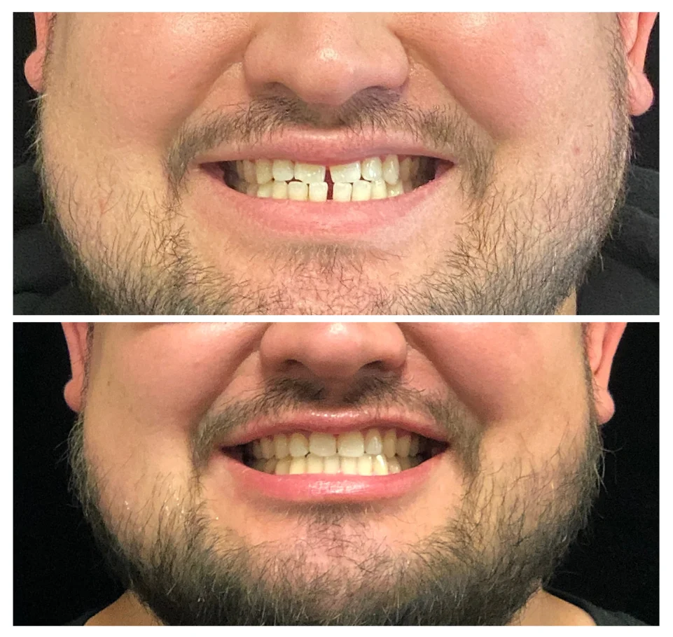 sala invisalign before after 04