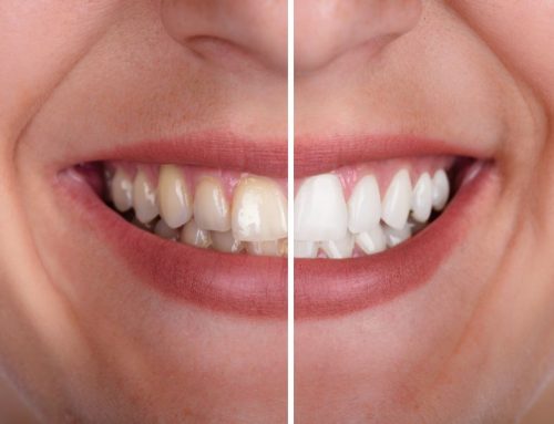 Is Teeth Whitening Safe? What Dentists Want You to Know