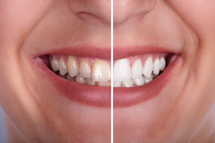 Is Teeth Whitening Safe? What Dentists Want You to Know